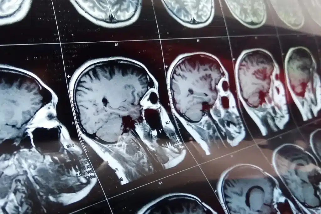 Brain scans.